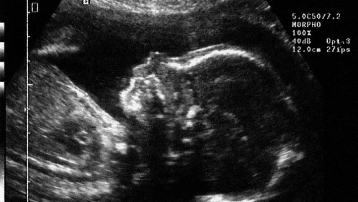 Hong Kong enceinte de jumeaux avant même de naître