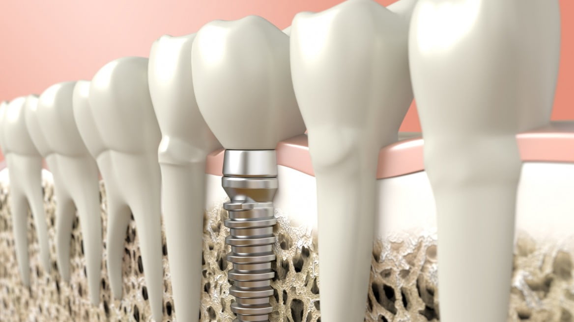 Nouvelle technologie israélienne pour les implants dentaires