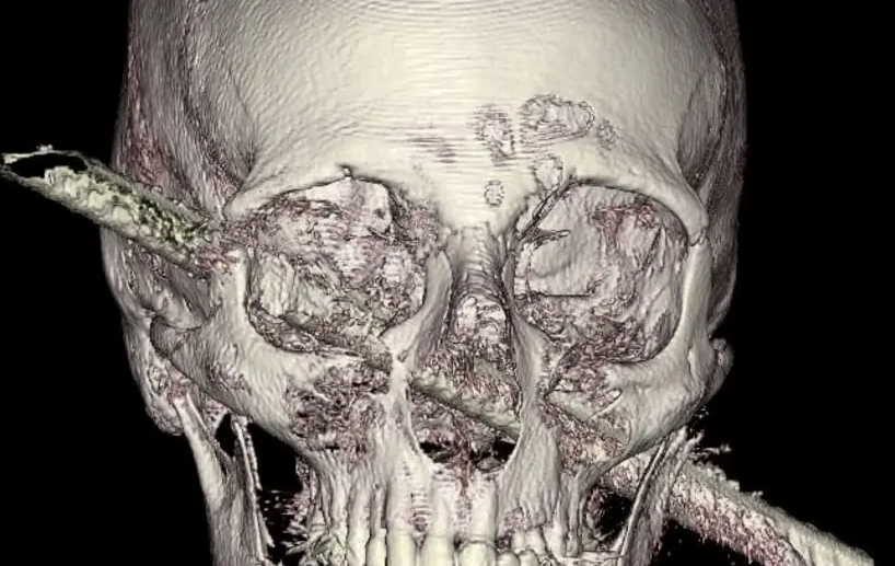 Image d'une tige à travers la tête de Kamel Abdel Rahman (crédit photo: HADASSAH SPOKESPERSON)