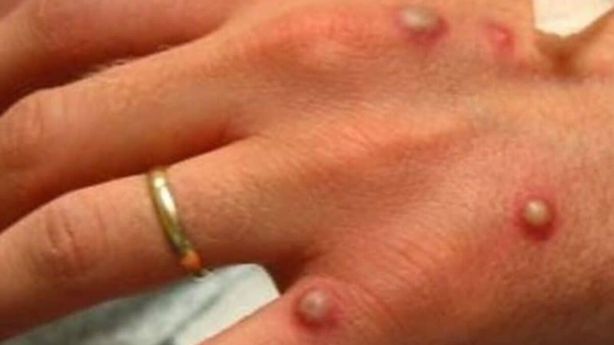 101 infections à la variole du singe, Israël signe un accord pour un vaccin