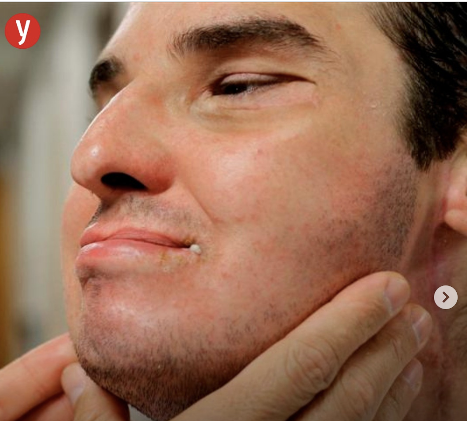 Greffe de visage en Israël : ce que dit la médecine, ce que murmure le Talmud