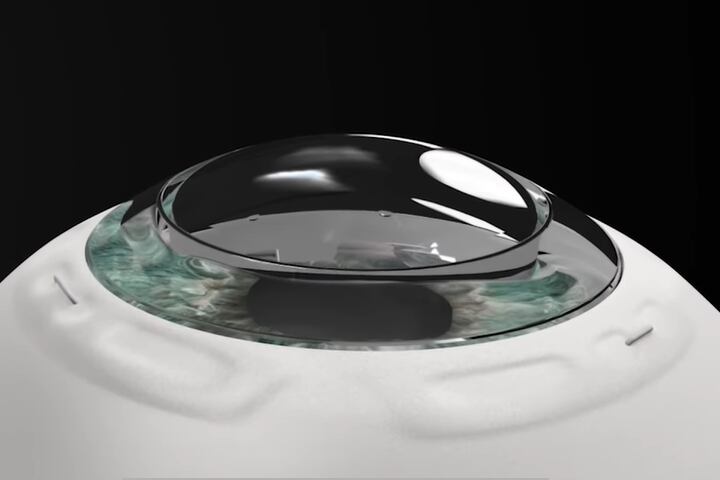 CorNeat KPro : la cornée artificielle israélienne qui redonne la vue aux aveugles