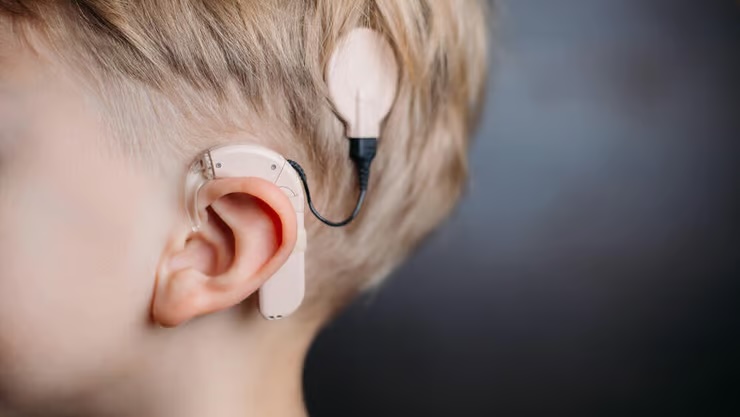 La Clalit réclame près de 15 millions de shekels pour des implants cochléaires défectueux