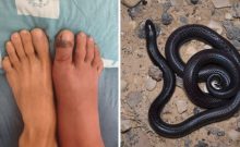 Mordu par un serpent sans antidote : comment les médecins israéliens ont sauvé Moshe de justesse