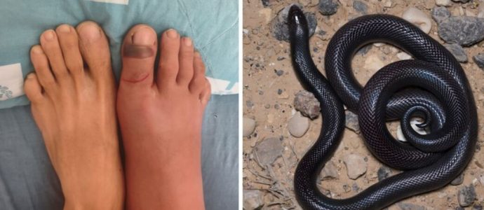 Mordu par un serpent sans antidote : comment les médecins israéliens ont sauvé Moshe de justesse