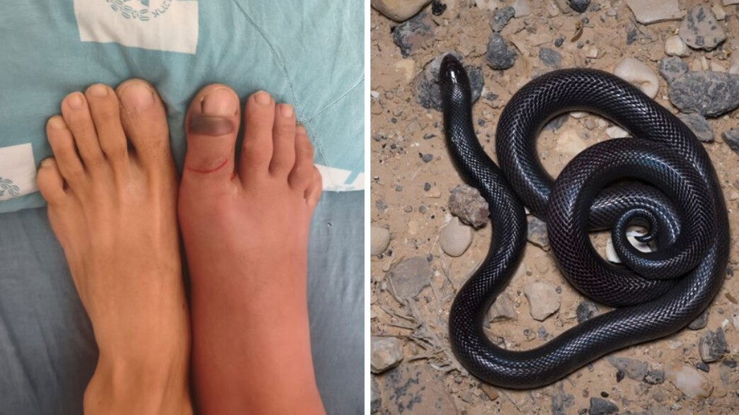Mordu par un serpent sans antidote : comment les médecins israéliens ont sauvé Moshe de justesse