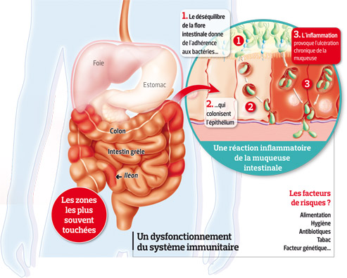 Maladie-de-Crohn2_apercu.jpg