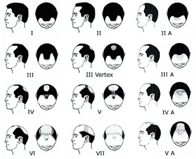 Des prémices de cheveux cultivés en laboratoire