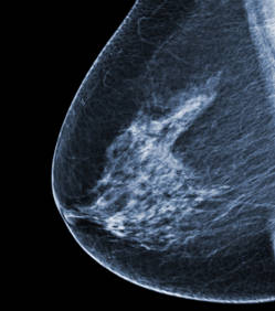 Un traitement contre le cancer du sein approuvé aux Etats-Unis